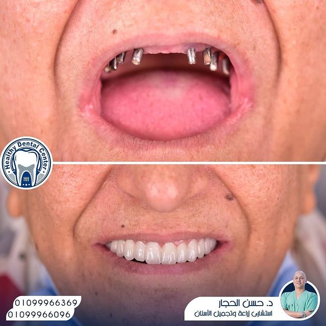 عملية زراعة الأسنان
